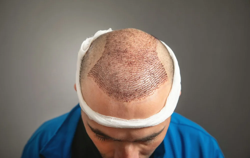 Hair Transplant & Hair Fall Treatments (1)