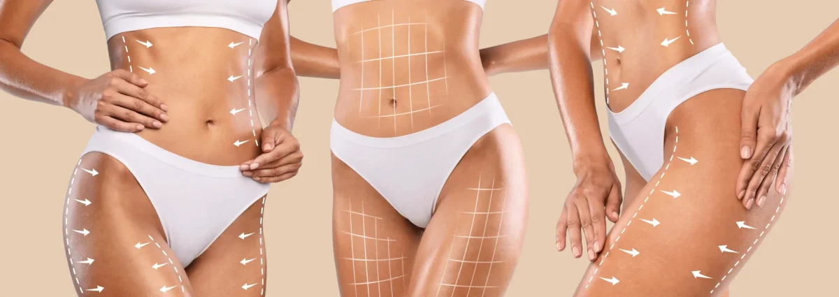 Liposuction & Body Contouring